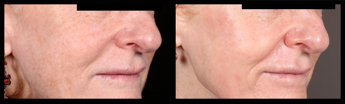 Fraxel Dual for freckles and skin rejuvenation