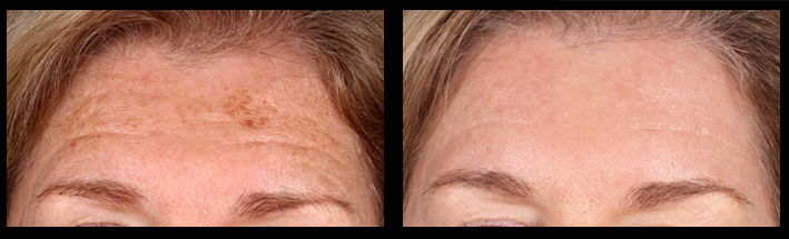 Fraxel Dual for sundamage on forehead