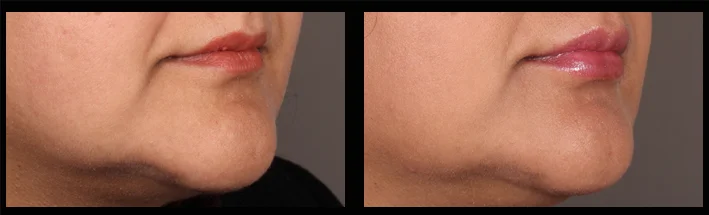 Dermal fillers for lip enhancement