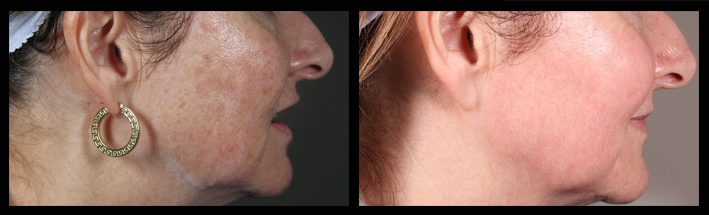 Fraxel Dual for brown spots