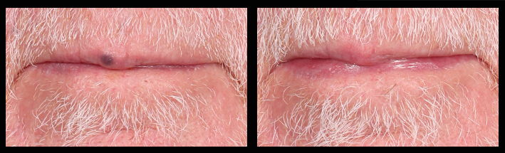 Vascular Laser for lip lesion