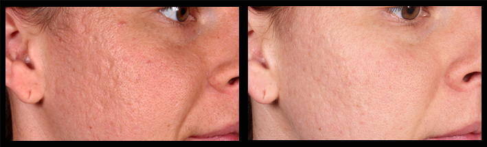 Combination of Venus Viva & Dermal Filler for acne scarring