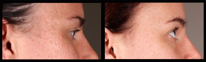 Venus Viva & Dermal Fillers for acne scarring