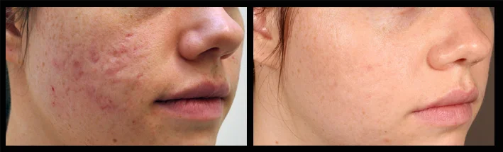 Dermal Filler for acne scars