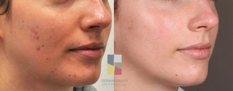 An example of an adult with acne that was treated at the Dermatology Institute of Victoria 