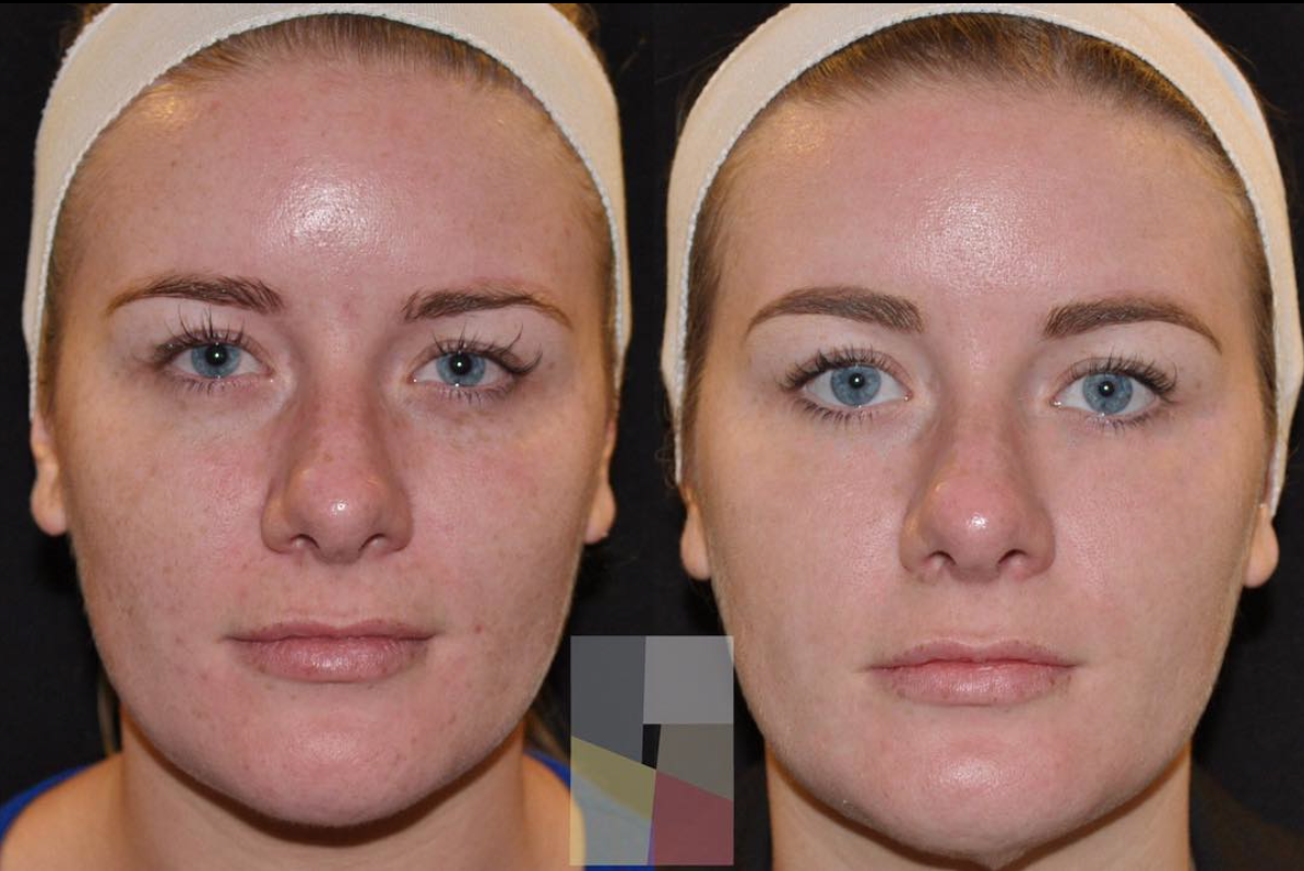Before & After Fraxel Treatment at The Dermatology Institute of Victoria