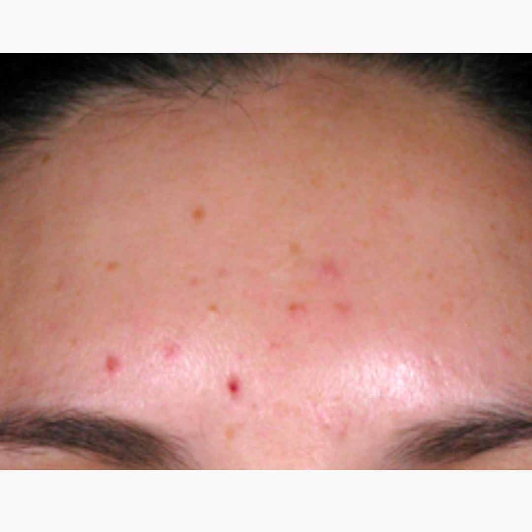 Light Skin Peel for Acne: Before