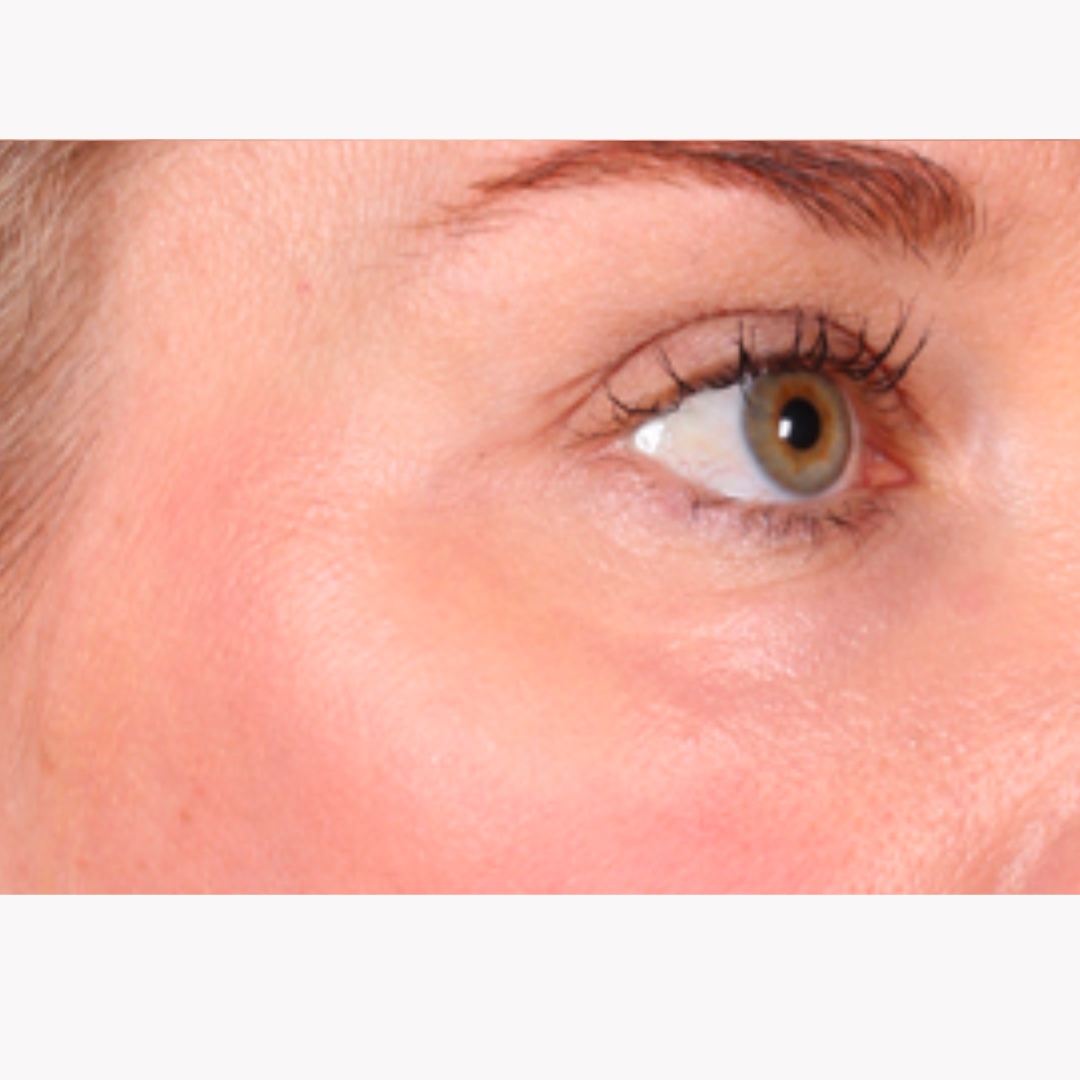 Plasma Skin Resurfacing PSR at the Dermatology Institute of Victoria ...