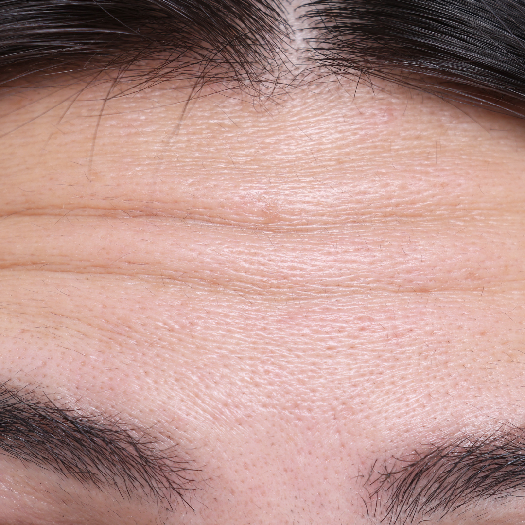 Forehead Lines