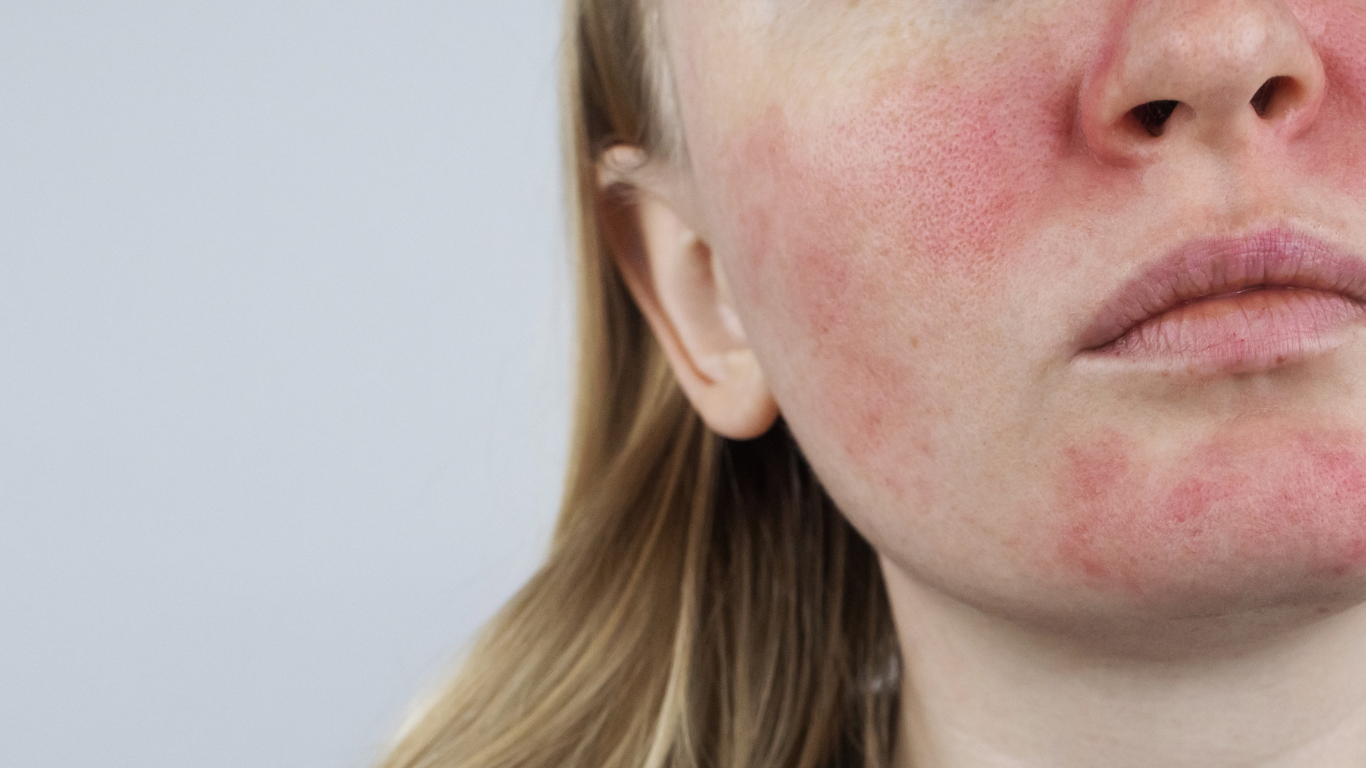 Rosacea and Redness — The Dermatology Institute of Victoria | Melbourne ...