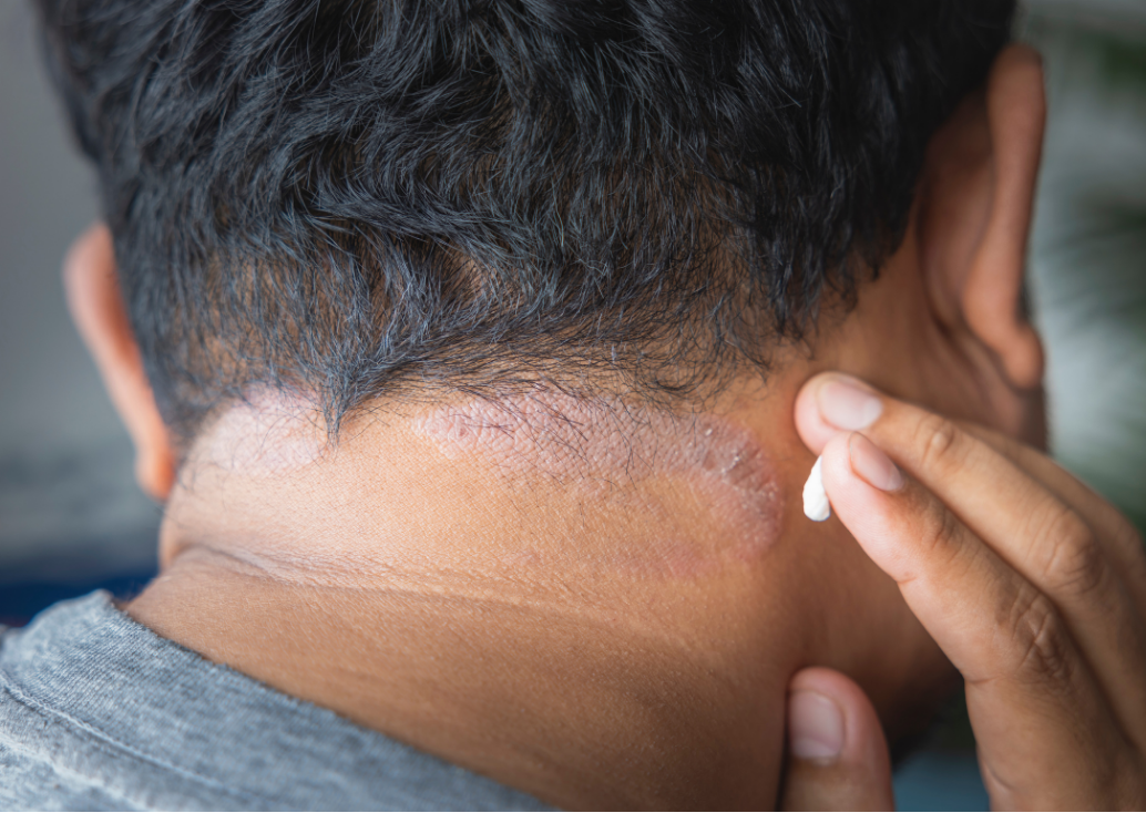 Seborrhoeic Dermatitis