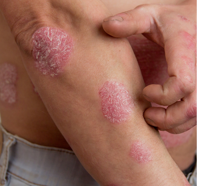 Plaque Psoriasis