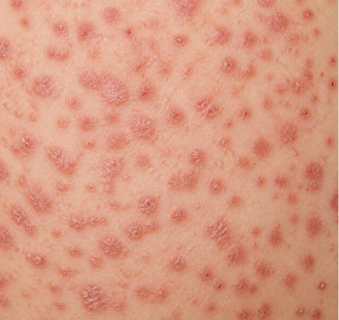 Guttate Psoriasis