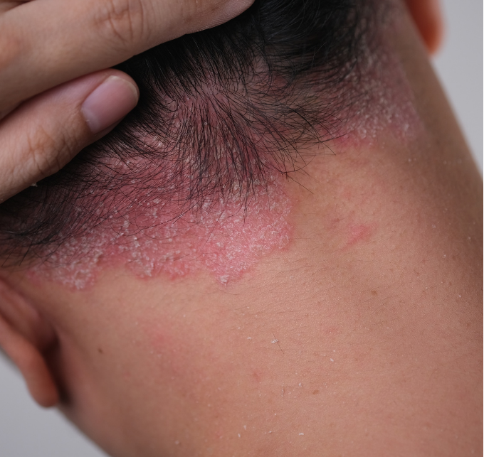 Scalp Psoriasis