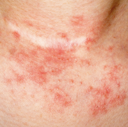 Atopic Dermatitis