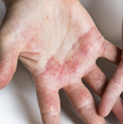 Contact Dermatitis