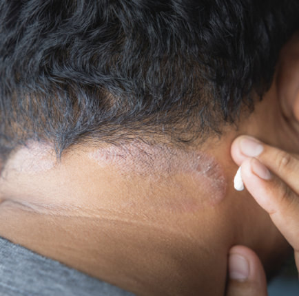 Seborrhoeic Dermatitis