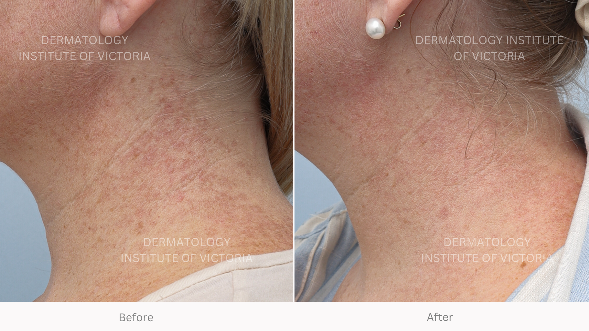Intense Pulsed Light (IPL) — The Dermatology Institute of Victoria ...
