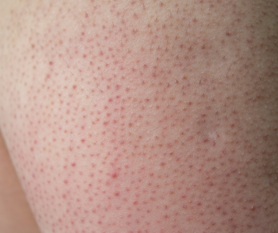 Keratosis Pilaris — The Dermatology Institute of Victoria | Melbourne ...