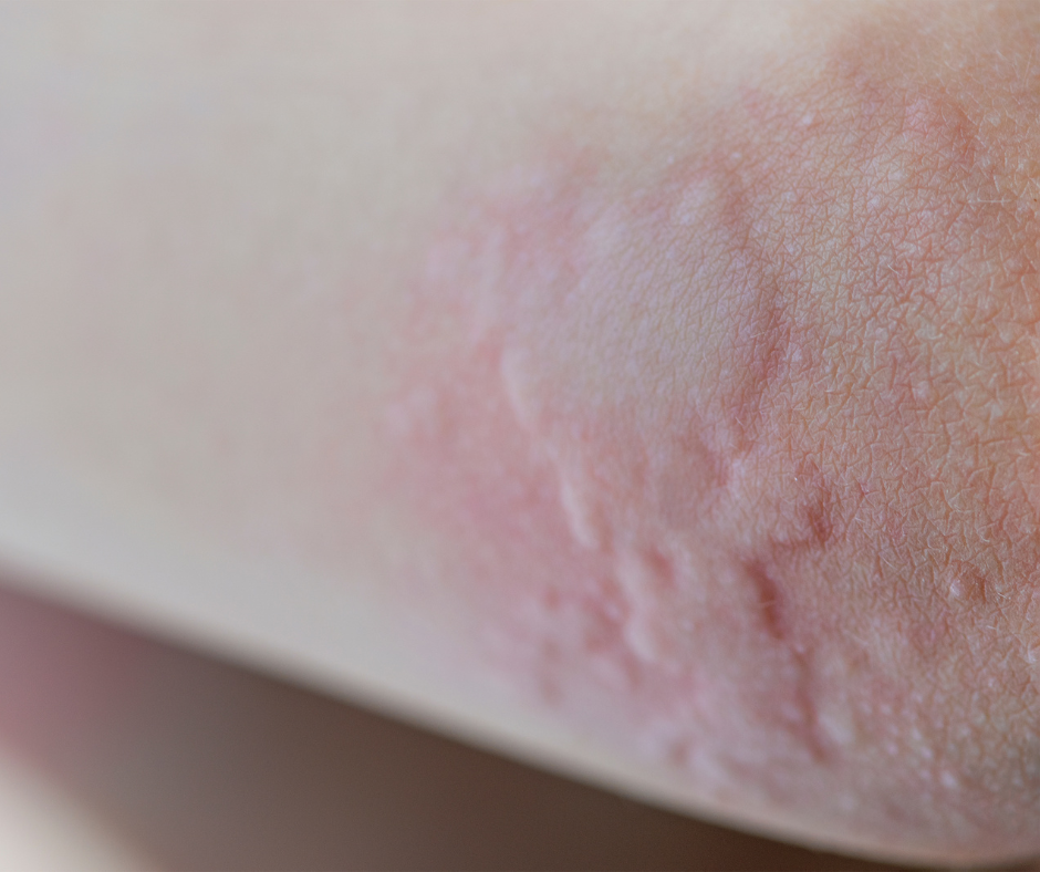 Keratosis Pilaris — The Dermatology Institute of Victoria | Melbourne ...