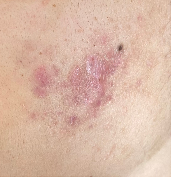 Post Inflammatory Rash The Dermatology Institute of Victoria | Melbourne Dermatologists— Can ...