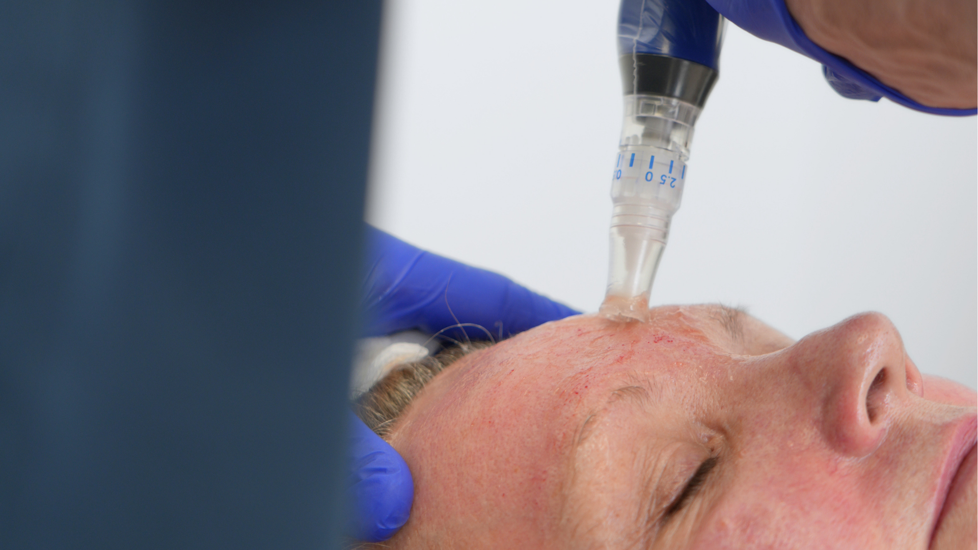 How do you know if skin needling is right for your skin?
