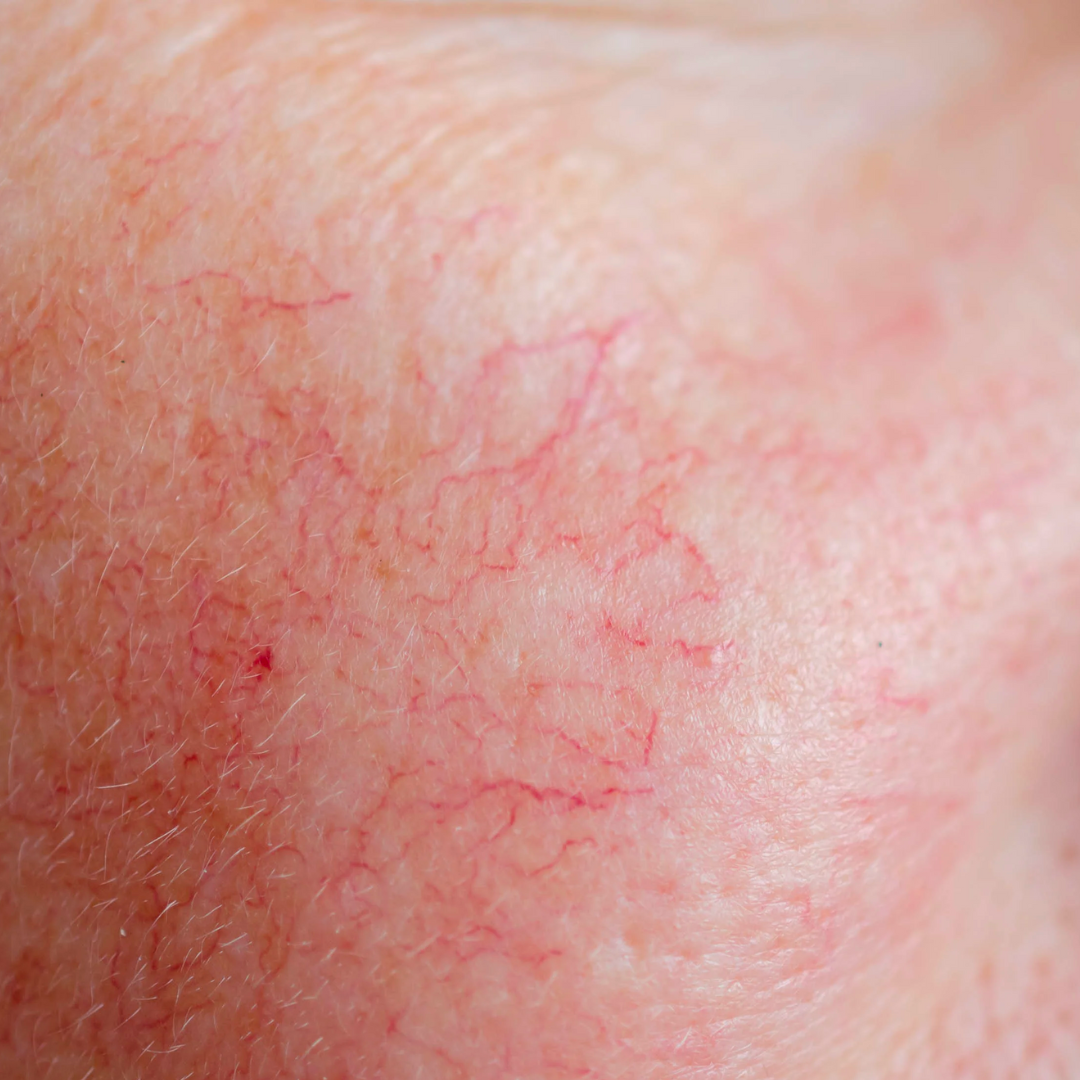 How to treat Redness at the Dermatology Institute of Victoria Melbourne ...