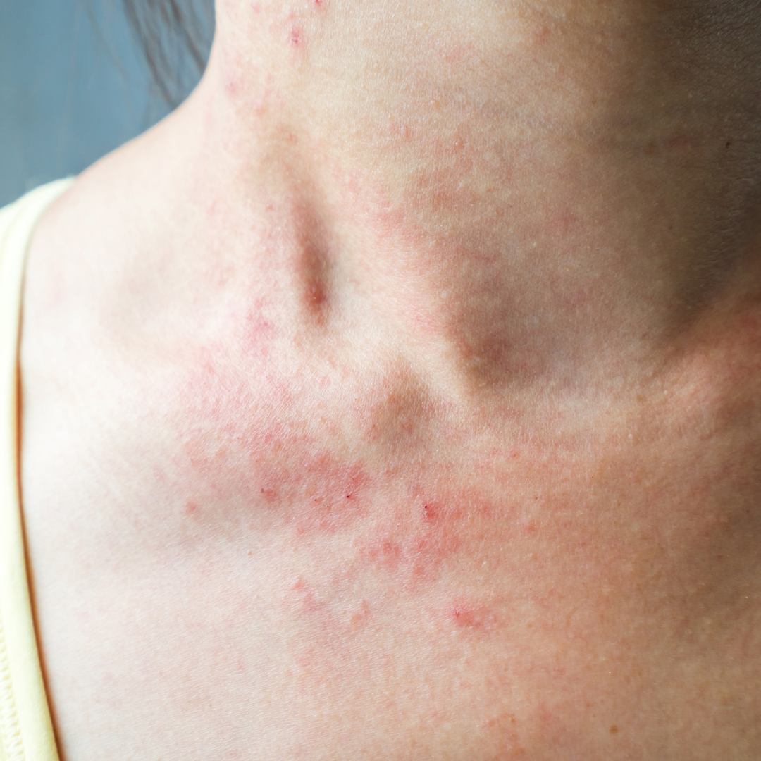 How Eczema And Psoriasis Is Treated At