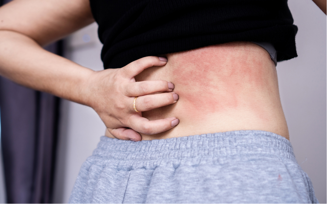 When Should You Be Concerned About Hives?
