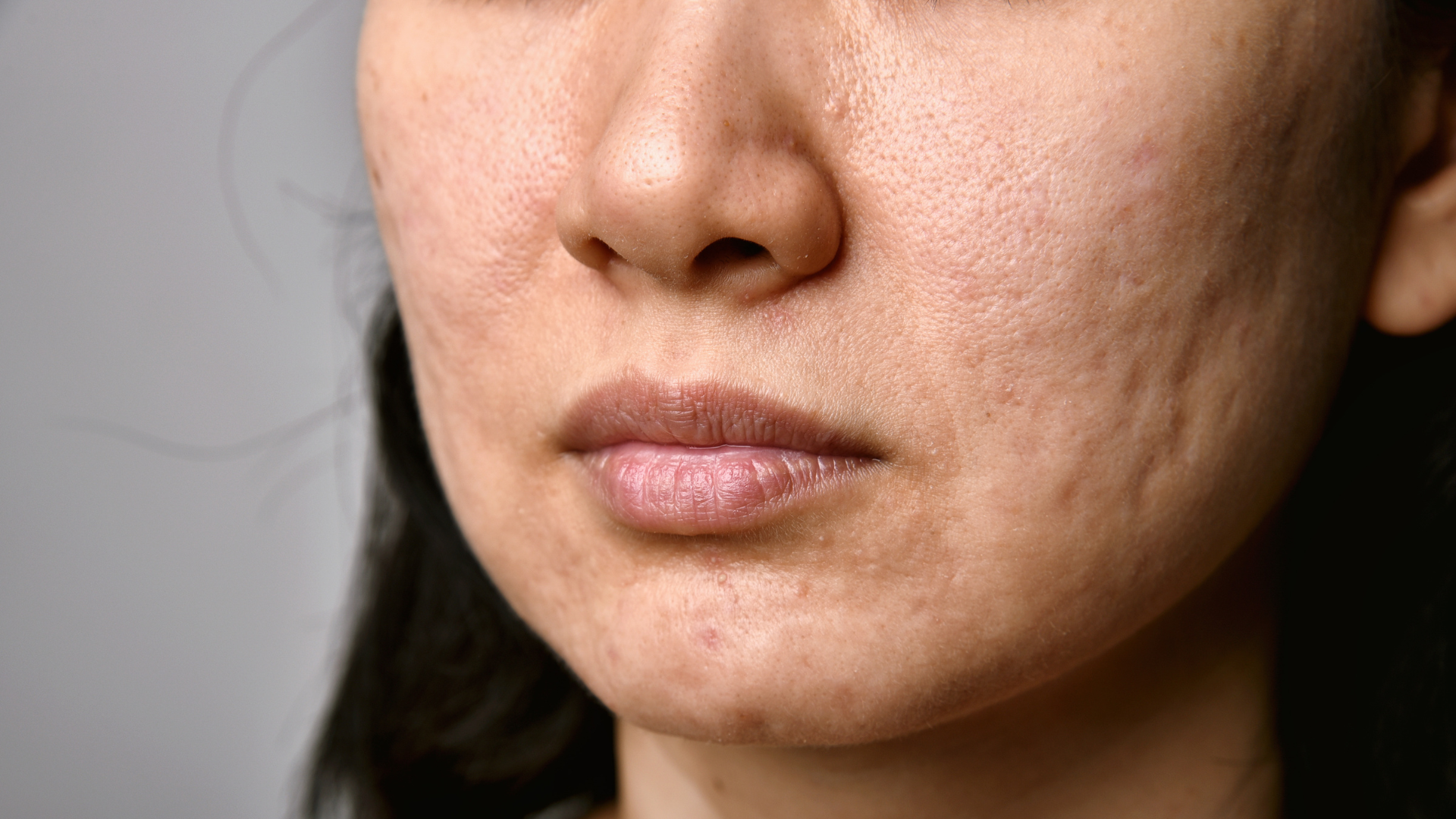 Can acne scars be treated years later?