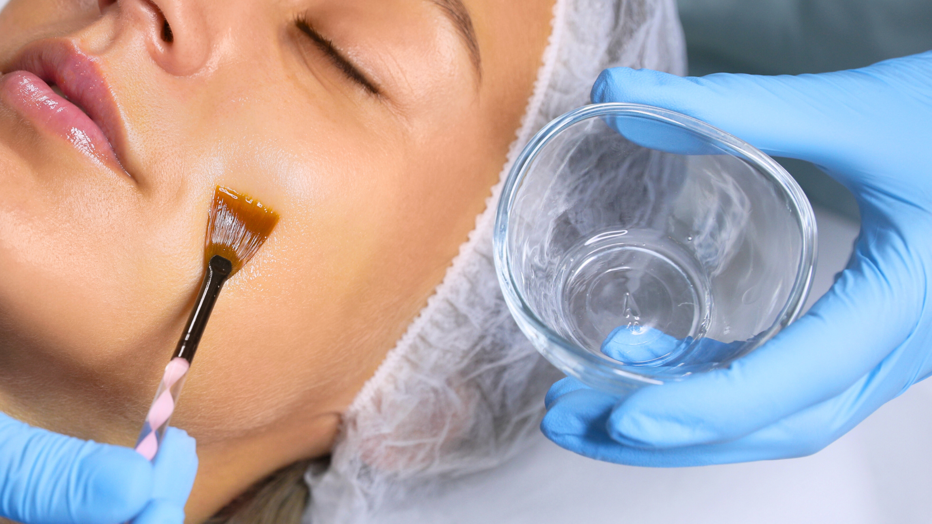 A Beginner’s Guide to Chemical Peels