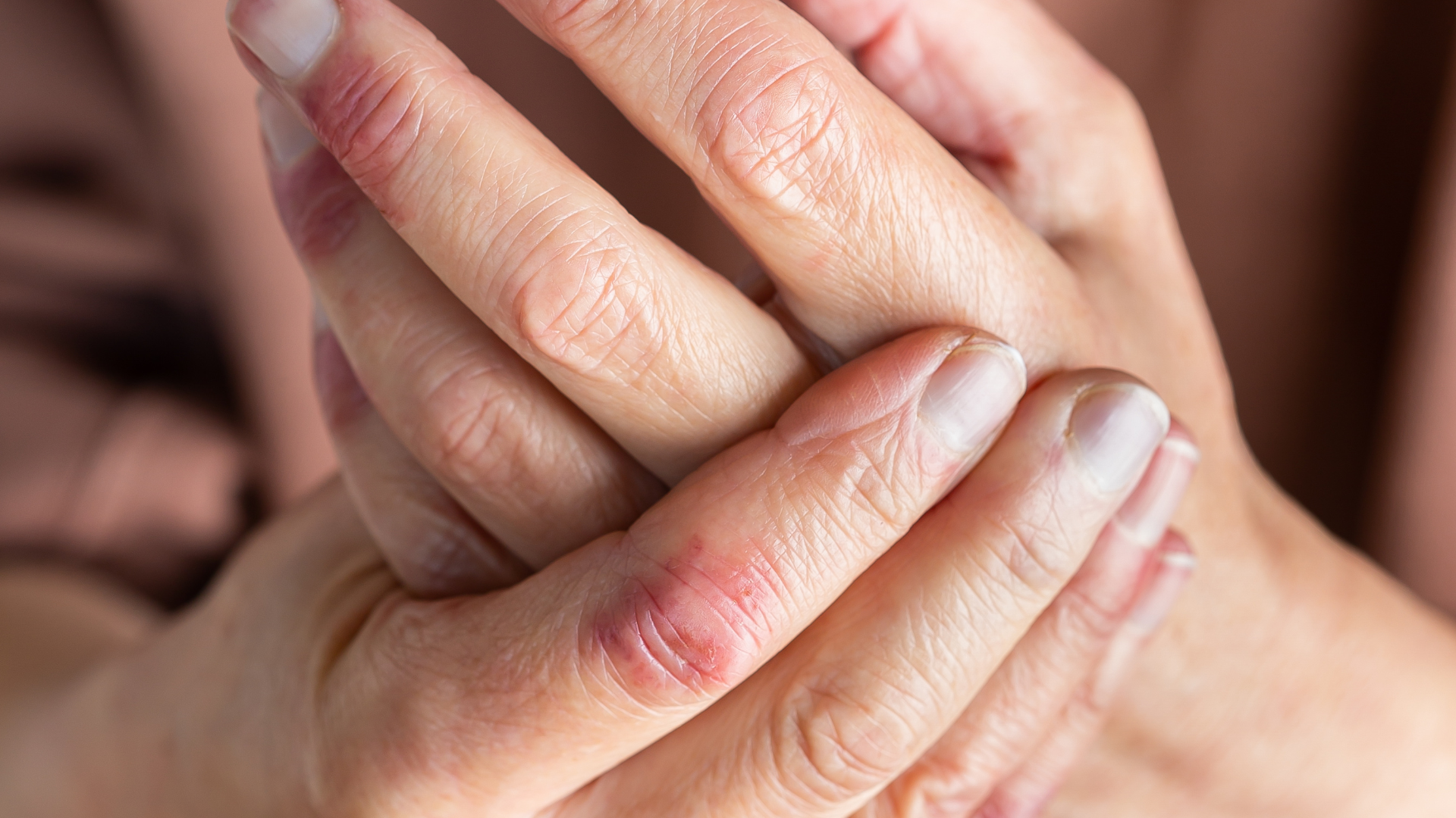 Can you develop eczema as an adult?