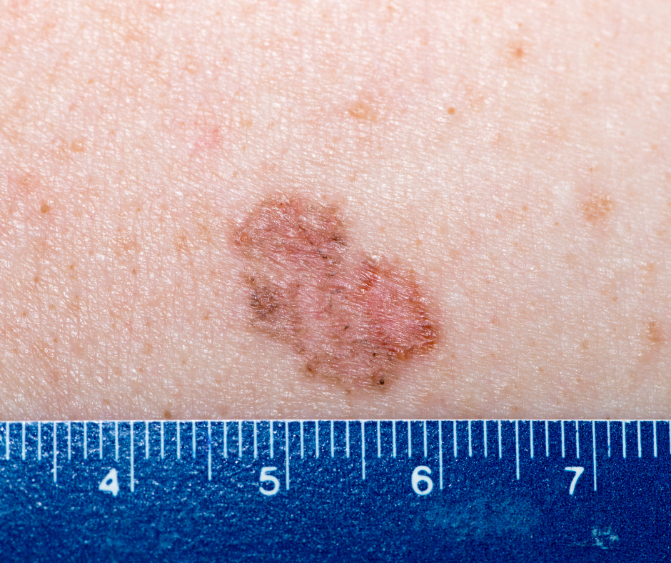 Photodynamic Rashes Photodynamic Therapy PDT — The Dermatology Institute of Victoria ...