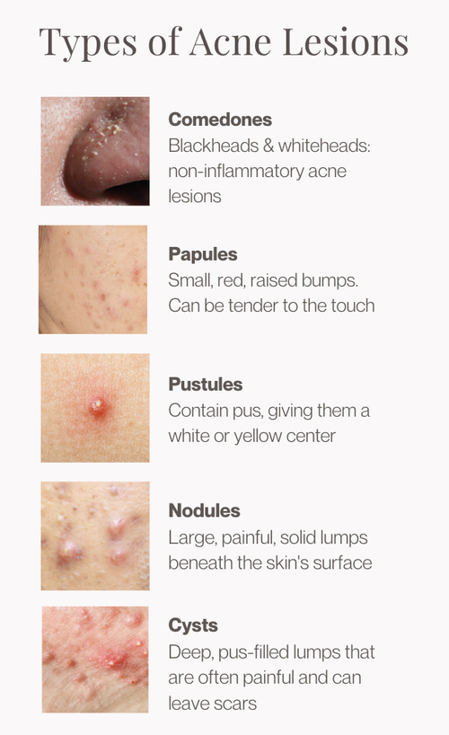 How Acne and Scarring is treated at the Dermatology Institute of ...