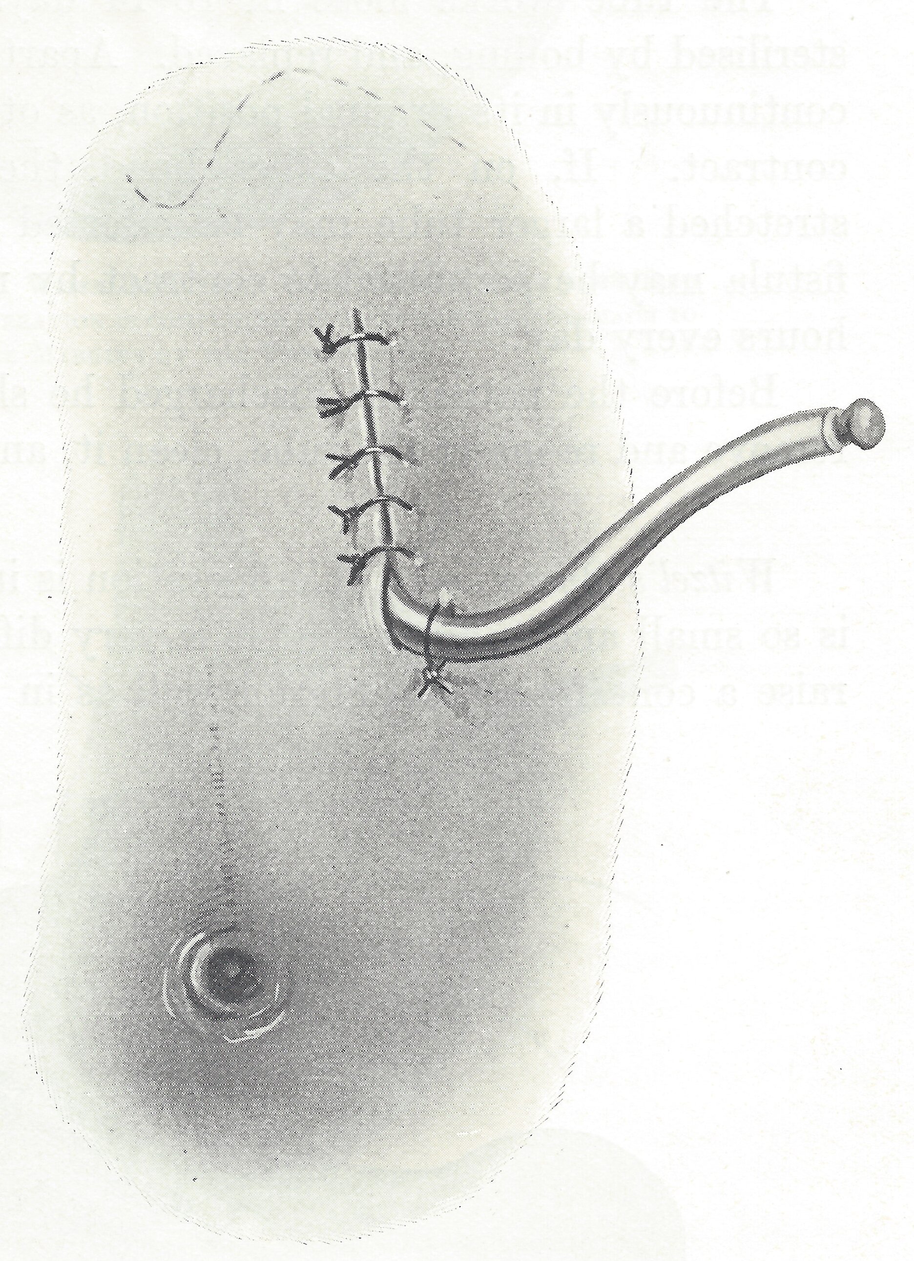The tube is drawn through the lower portion of the incision.jpg