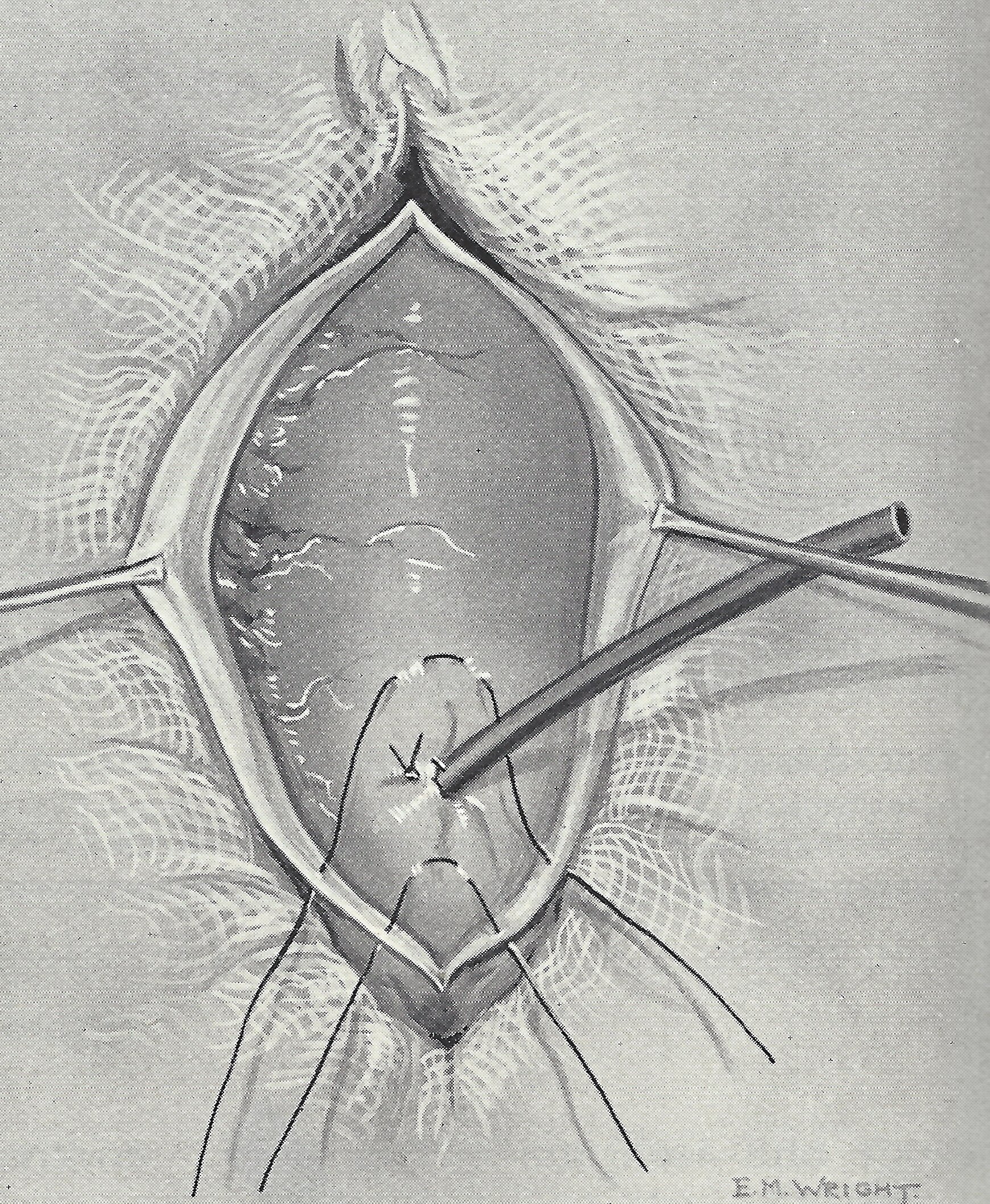 Upper suture is tied above and the lower suture below the tube.jpg