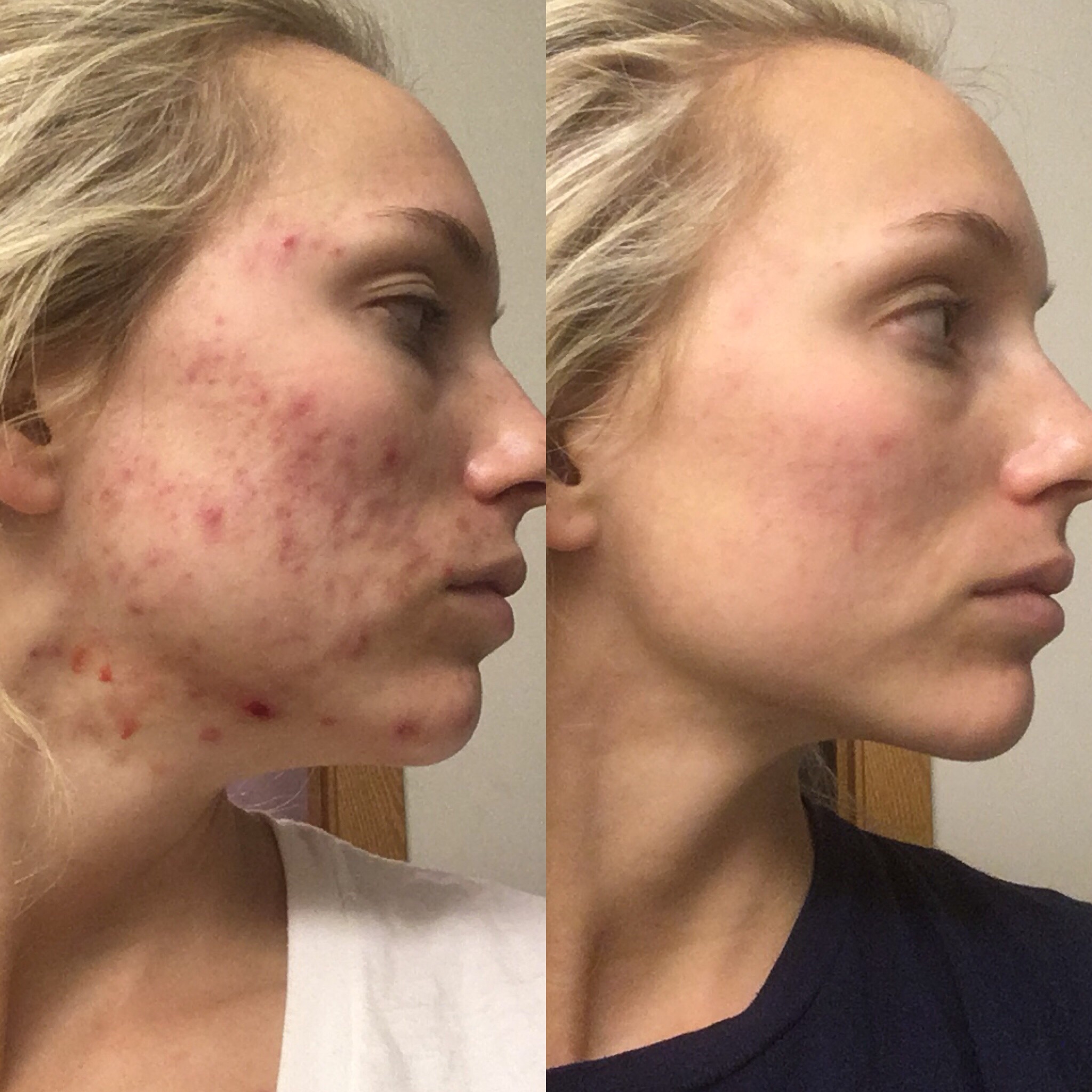 Luminous Beauty Client Before & After Acne Treatment with Peels and Skin Care