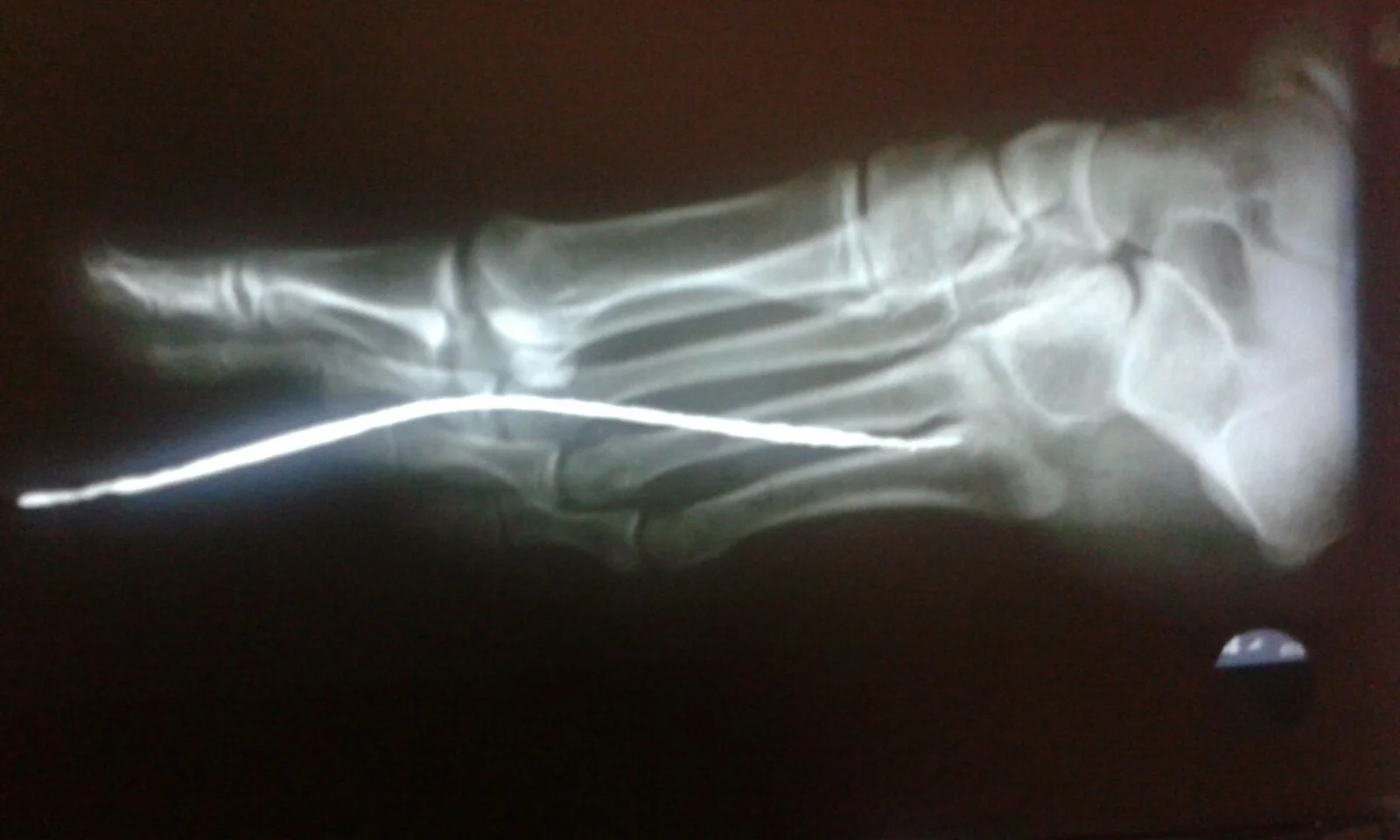 Jefferson's foot, still with the rebar embedded.