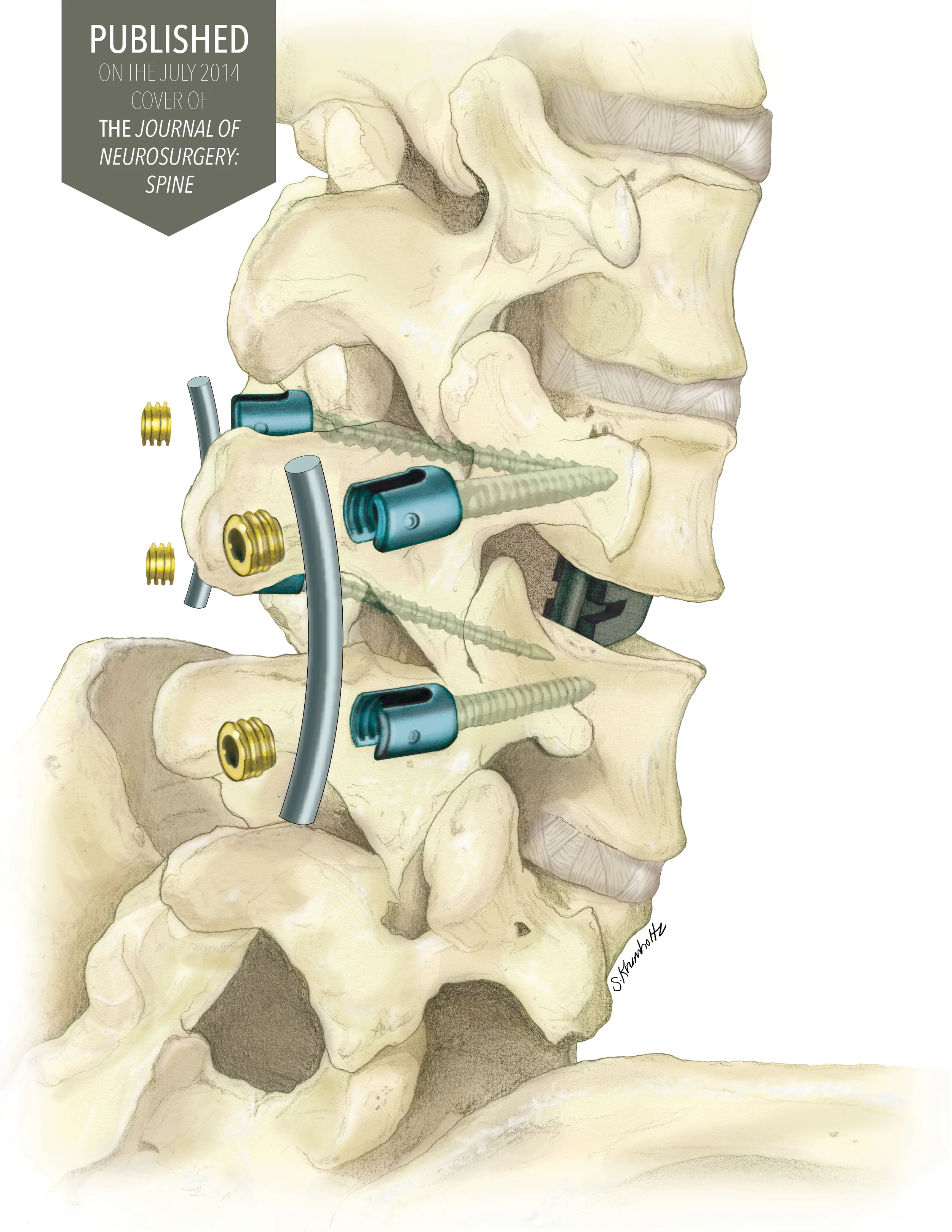 Journal of Neurosurgery: Spine
