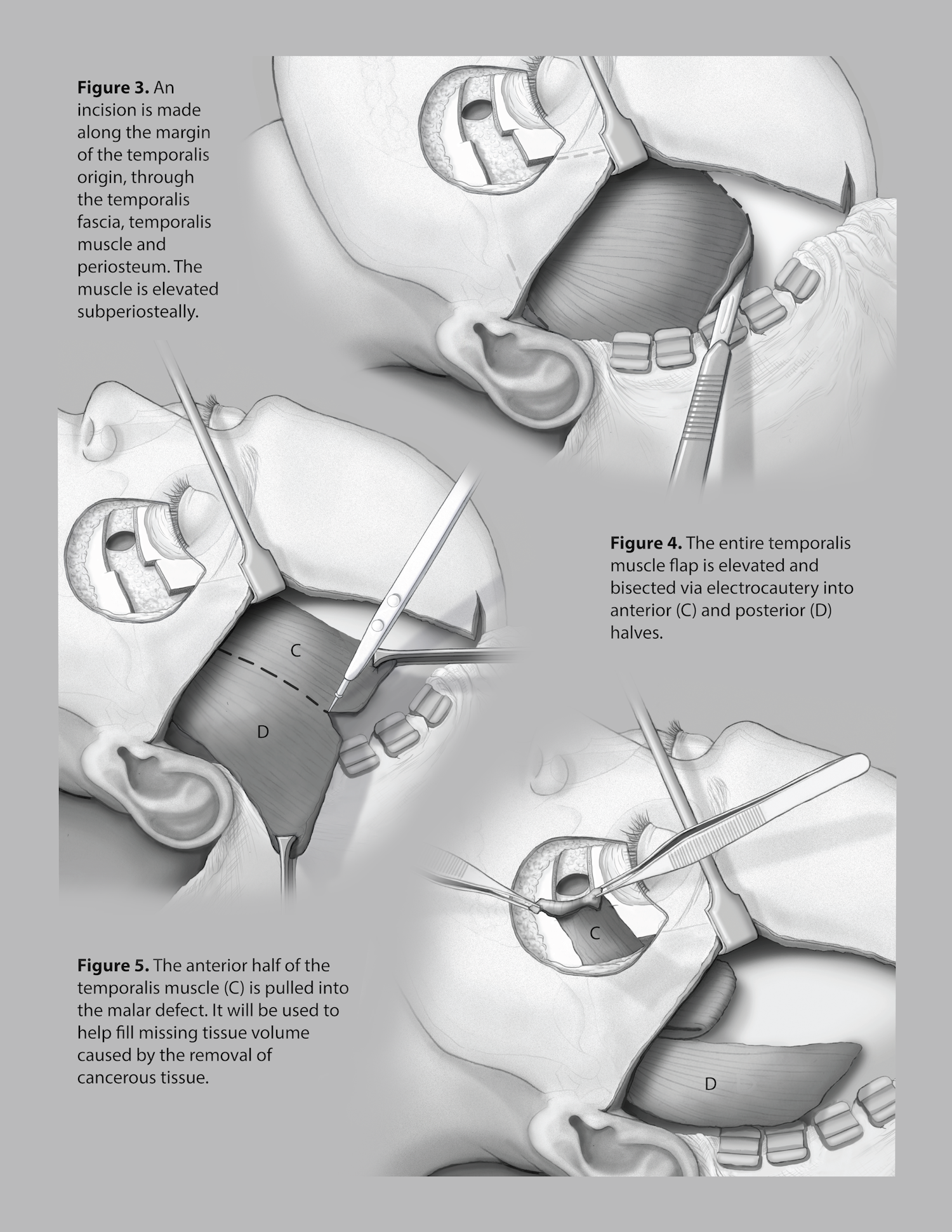 FINAL_SURGICAL_RENDER copy.png