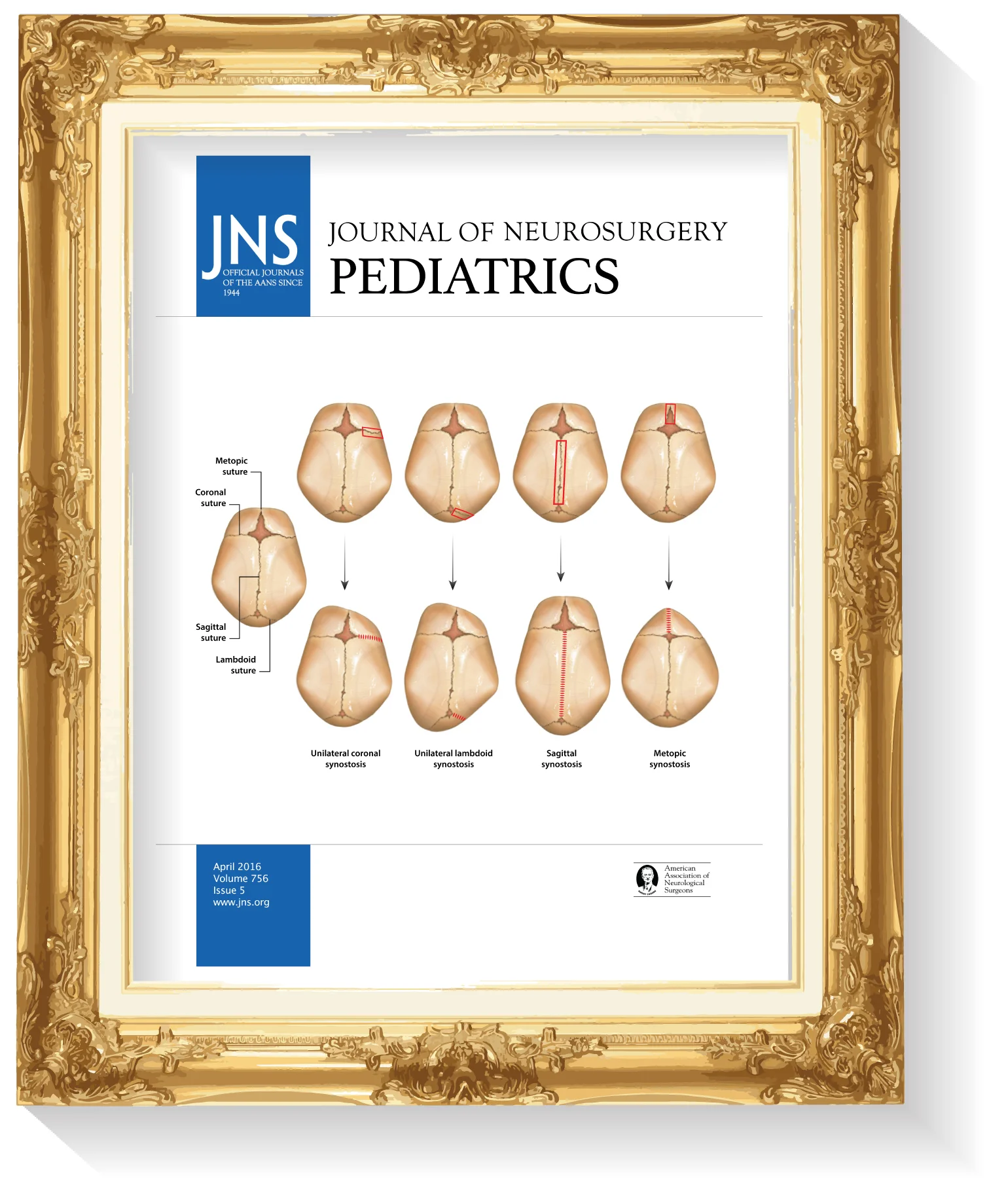 Framed_Craniosynostosis-03.jpg