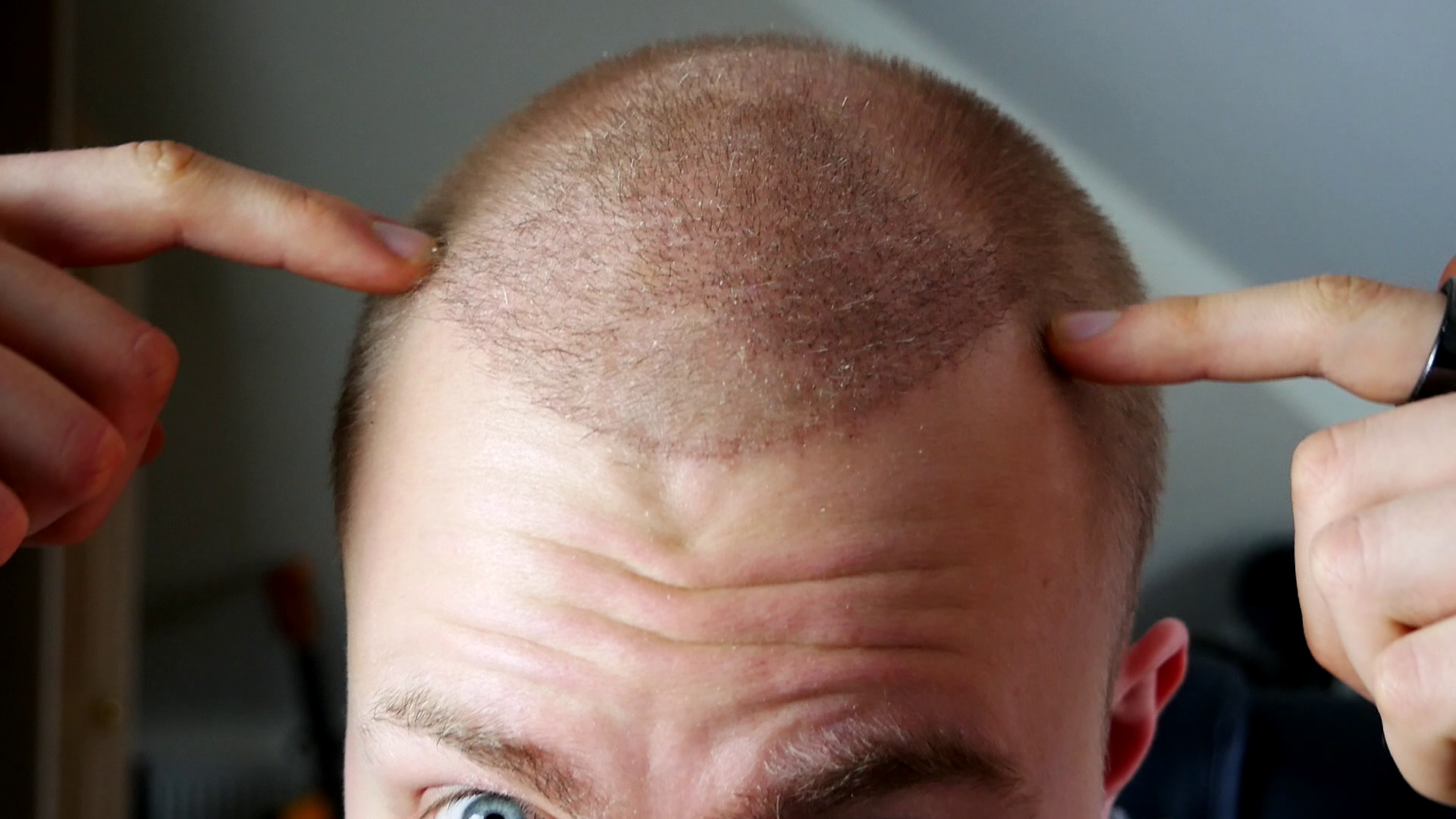 I Had a Hair Transplant (12 month results shown) — Jack Lawrence I Had a Hair Transplant (12 month results shown) — Jack Lawrence