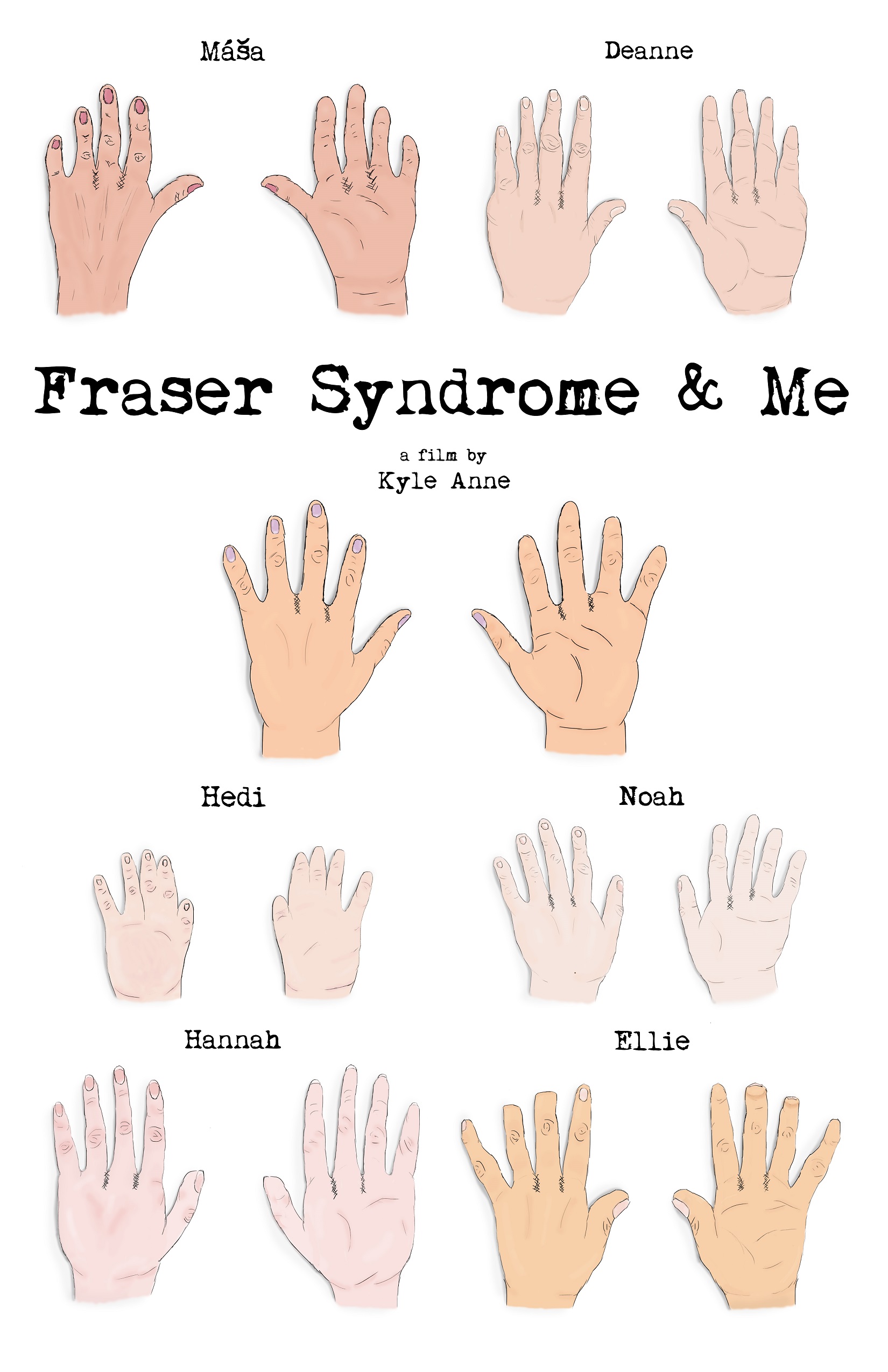 Fraser Syndrome & Me poster (Art Credit: Rachel Walters)