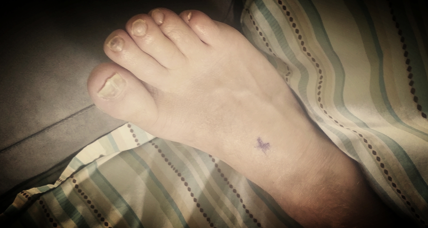 My right foot is marked with a black "x." My right cheek curiously sports a large orange "Yes." A bandage covers a wound that follows the crease beneath my buttocks. I haven't the courage (or flexibility) to look.