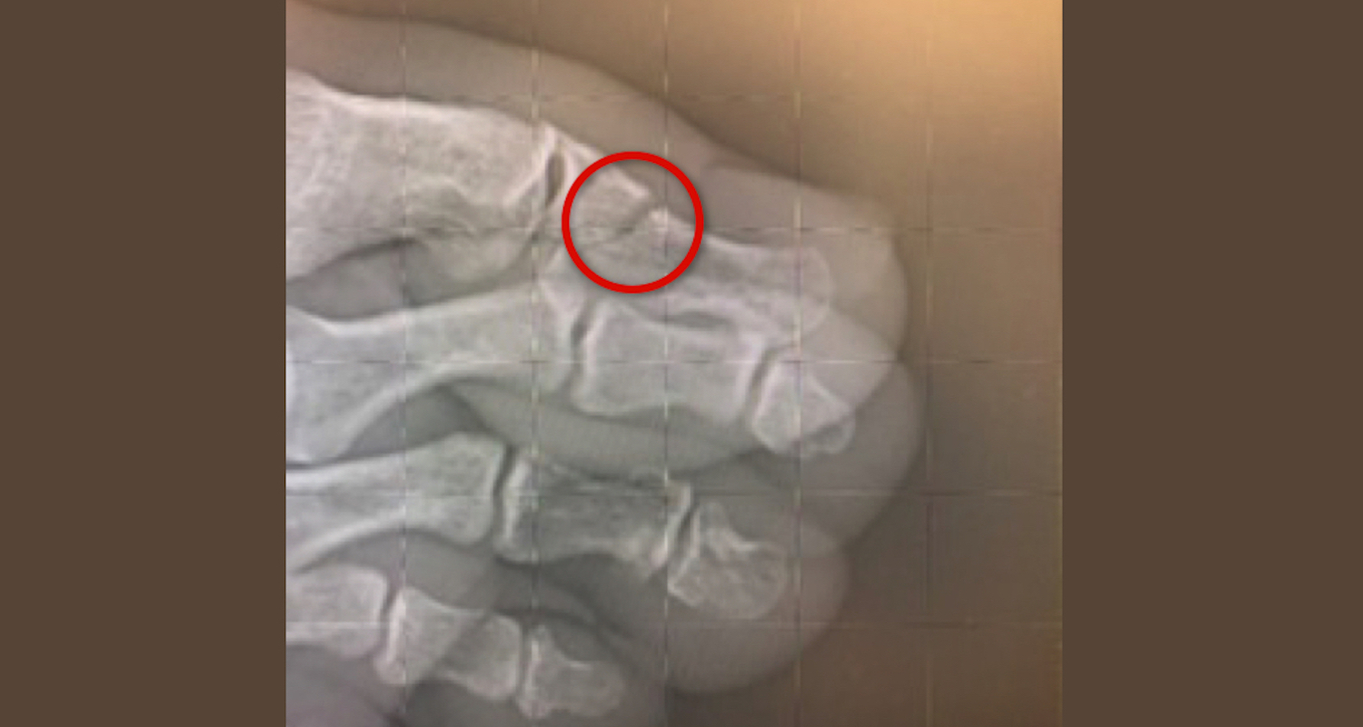A distal phalange in distress. There is something not-quite-right about seeing the insides of your own body.
