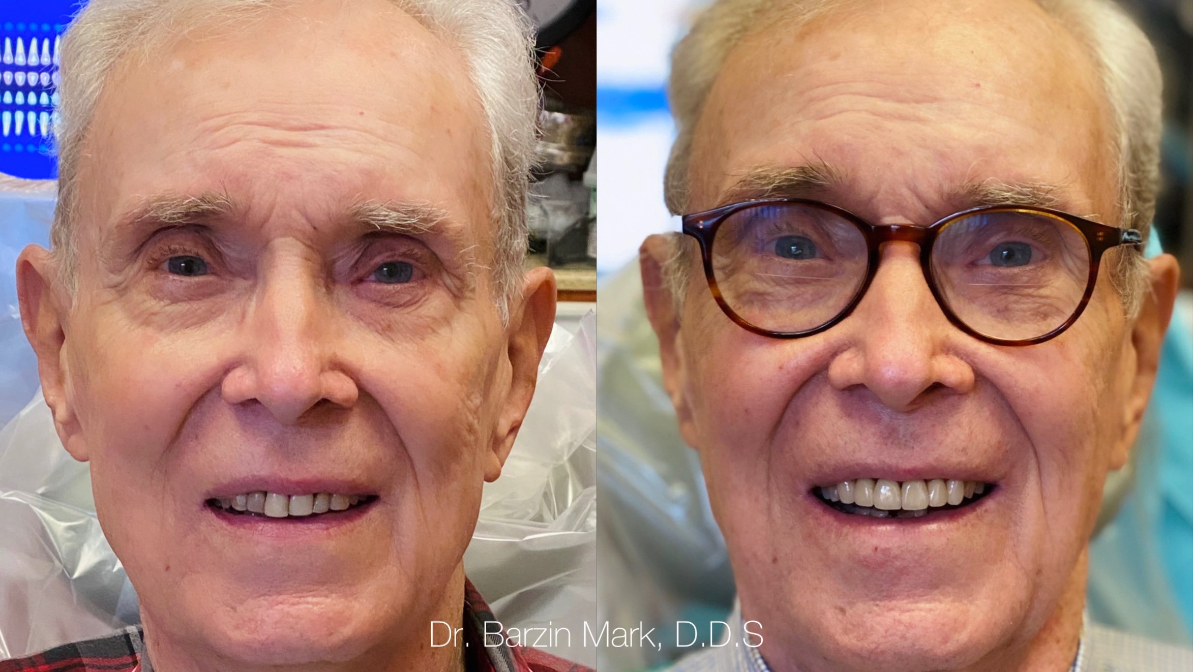 Full mouth restorative dentistry results for an older male patient by Dr. Barzin Mark.