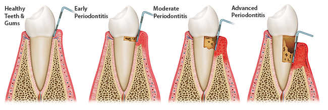Progression of periodontal disease.