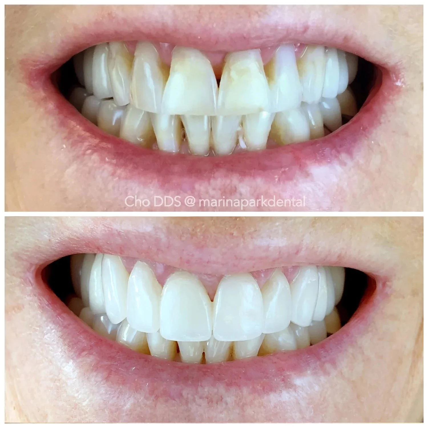 Smile transformation using six porcelain veneers to fill voids from gum recession and brighten the teeth shade.