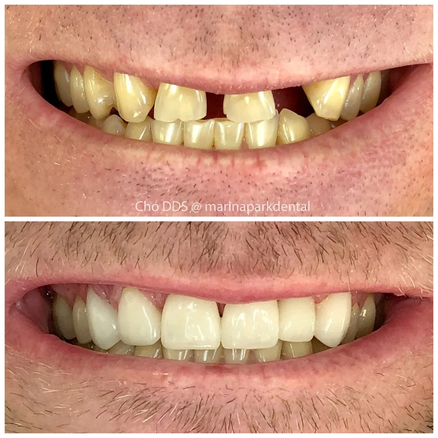 Before and after photos of missing teeth and spaces closed by porcelain crowns and bridges using CAD/CAM CEREC technology.