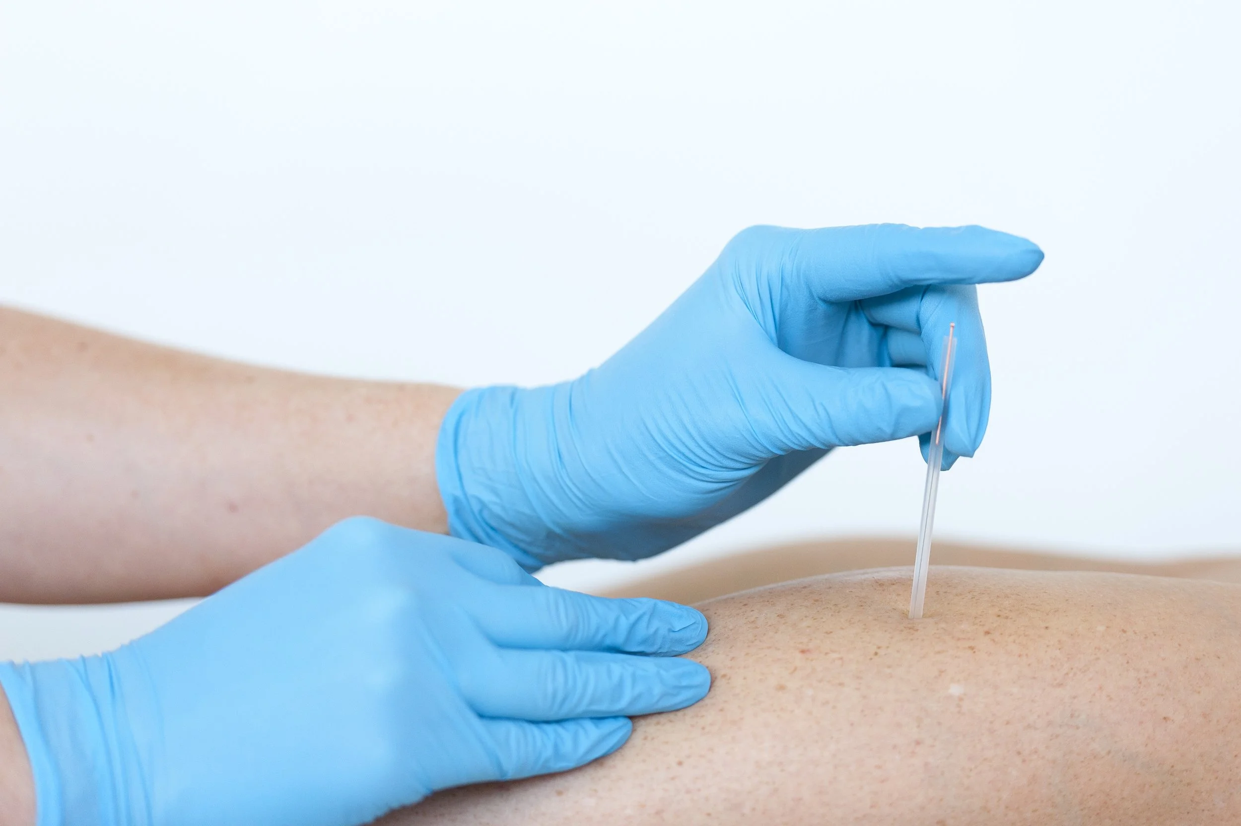 Dry Needling — Highett Podiatry Highett and Mentone
